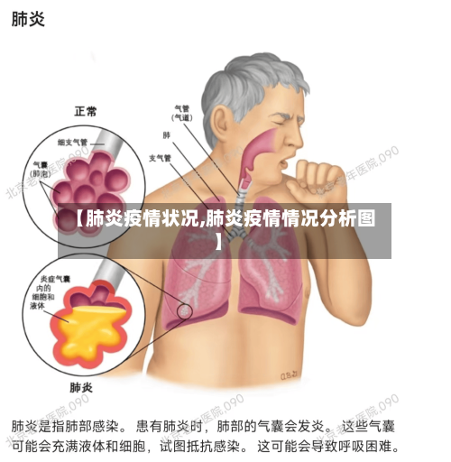 【肺炎疫情状况,肺炎疫情情况分析图】