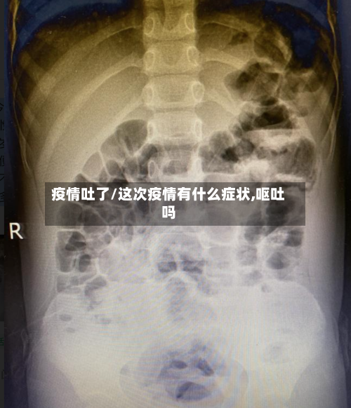 疫情吐了/这次疫情有什么症状,呕吐吗-第3张图片