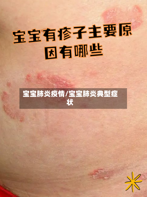 宝宝肺炎疫情/宝宝肺炎典型症状