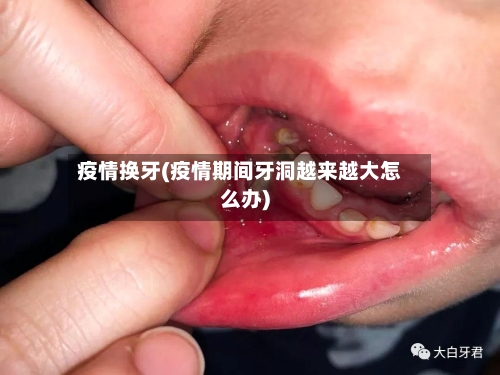 疫情换牙(疫情期间牙洞越来越大怎么办)-第2张图片