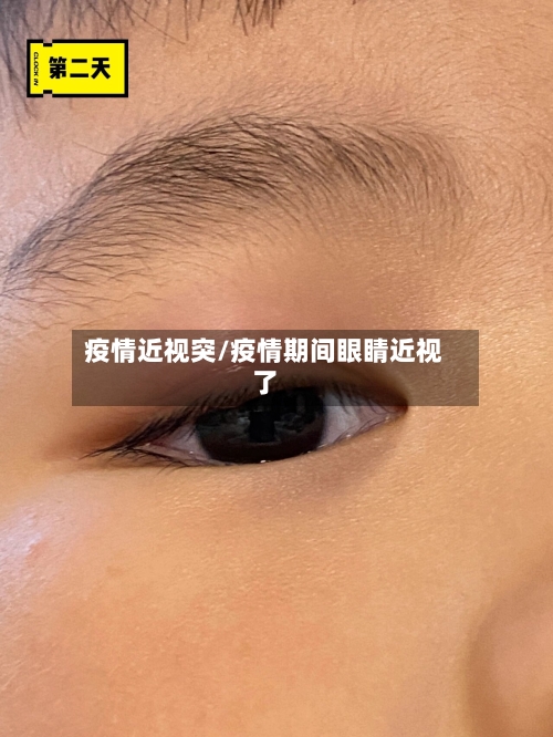 疫情近视突/疫情期间眼睛近视了-第2张图片