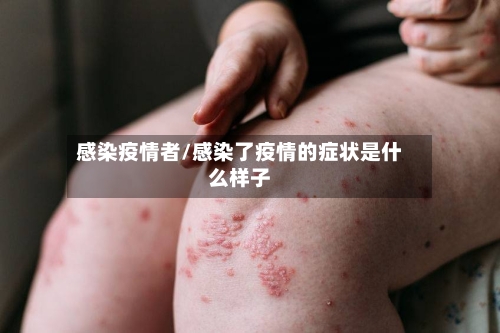 感染疫情者/感染了疫情的症状是什么样子