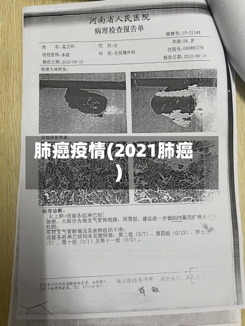 肺癌疫情(2021肺癌)-第2张图片