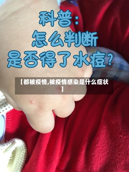 【都被疫情,被疫情感染是什么症状】