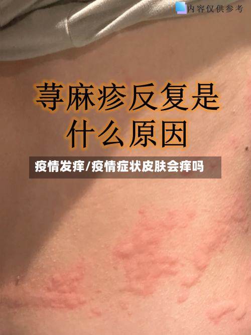 疫情发痒/疫情症状皮肤会痒吗