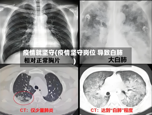 疫情就坚守(疫情坚守岗位 导致白肺)