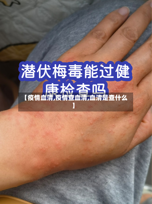 【疫情血清,疫情查血清,血清是查什么】