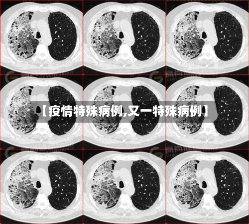 【疫情特殊病例,又一特殊病例】