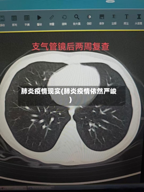 肺炎疫情现实(肺炎疫情依然严峻)