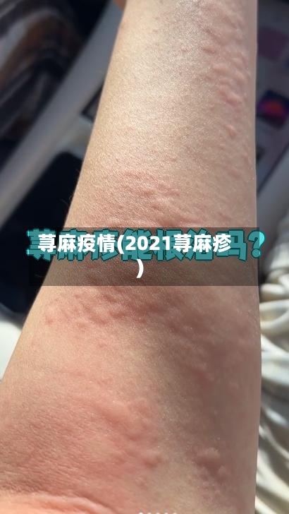 荨麻疫情(2021荨麻疹)