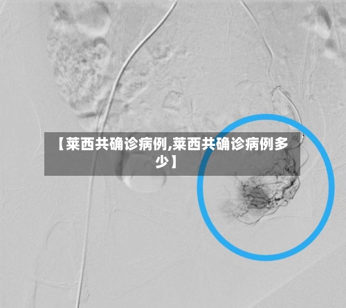 【莱西共确诊病例,莱西共确诊病例多少】