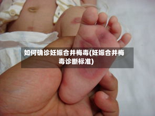 如何确诊妊娠合并梅毒(妊娠合并梅毒诊断标准)