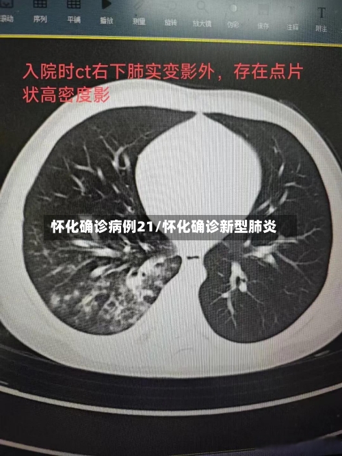 怀化确诊病例21/怀化确诊新型肺炎