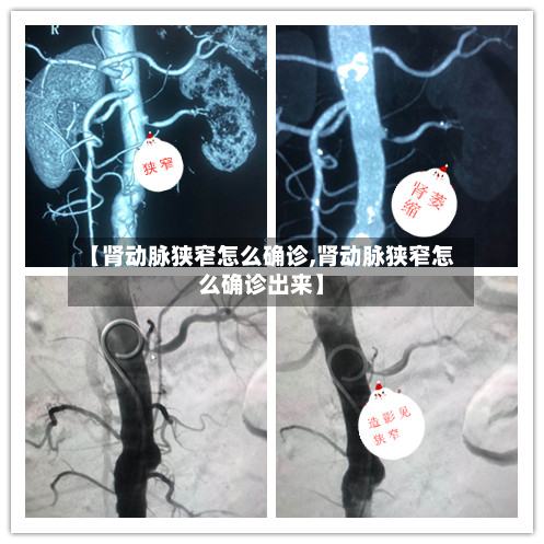 【肾动脉狭窄怎么确诊,肾动脉狭窄怎么确诊出来】