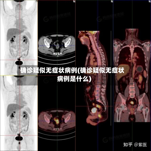 确诊疑似无症状病例(确诊疑似无症状病例是什么)