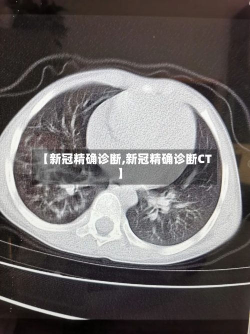 【新冠精确诊断,新冠精确诊断CT】