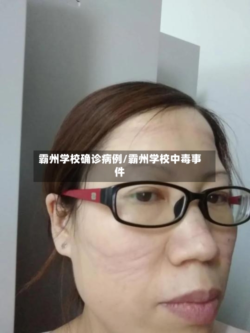 霸州学校确诊病例/霸州学校中毒事件