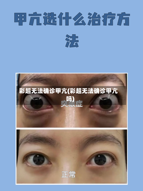 彩超无法确诊甲亢(彩超无法确诊甲亢吗)