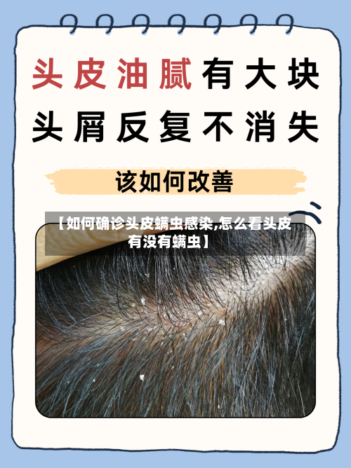 【如何确诊头皮螨虫感染,怎么看头皮有没有螨虫】