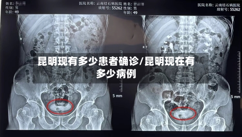 昆明现有多少患者确诊/昆明现在有多少病例