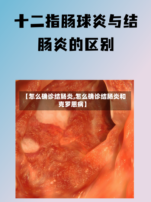 【怎么确诊结肠炎,怎么确诊结肠炎和克罗恩病】