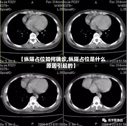 【纵隔占位如何确诊,纵隔占位是什么原因引起的】