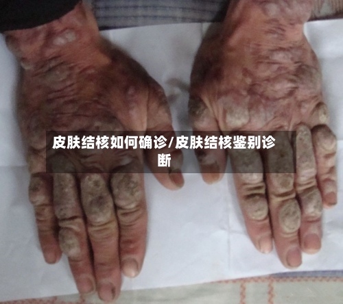 皮肤结核如何确诊/皮肤结核鉴别诊断