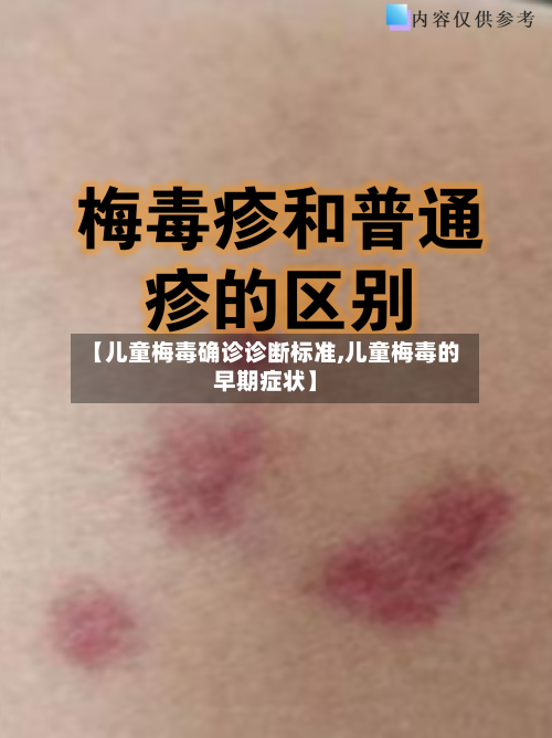 【儿童梅毒确诊诊断标准,儿童梅毒的早期症状】