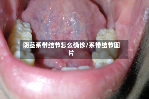阴茎系带结节怎么确诊/系带结节图片