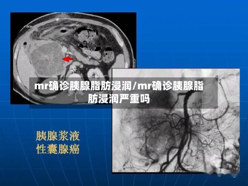 mr确诊胰腺脂肪浸润/mr确诊胰腺脂肪浸润严重吗