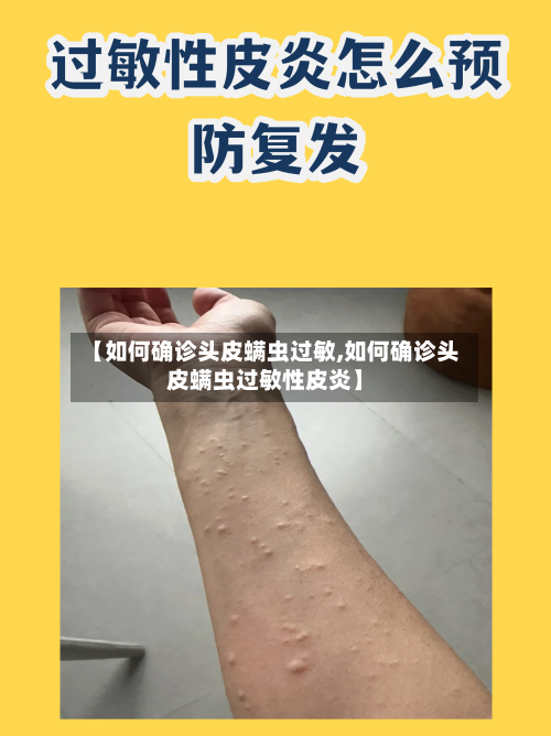 【如何确诊头皮螨虫过敏,如何确诊头皮螨虫过敏性皮炎】
