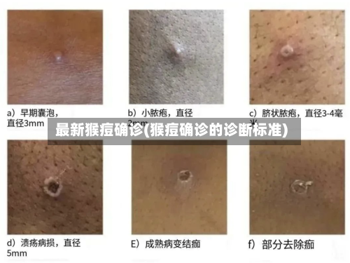 最新猴痘确诊(猴痘确诊的诊断标准)