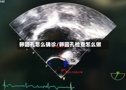 卵圆孔怎么确诊/卵圆孔检查怎么做