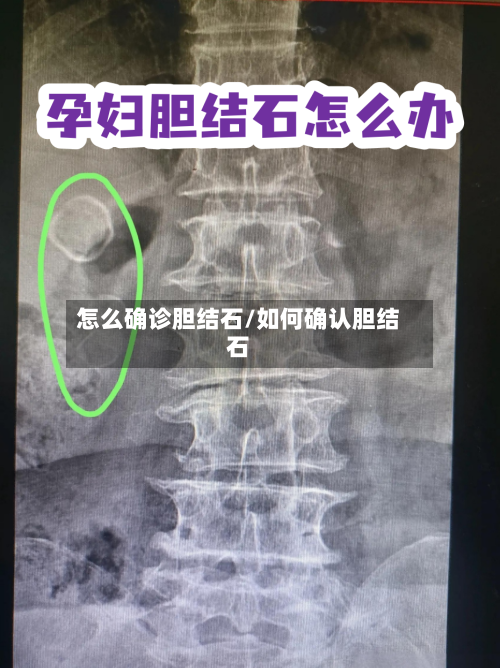 怎么确诊胆结石/如何确认胆结石