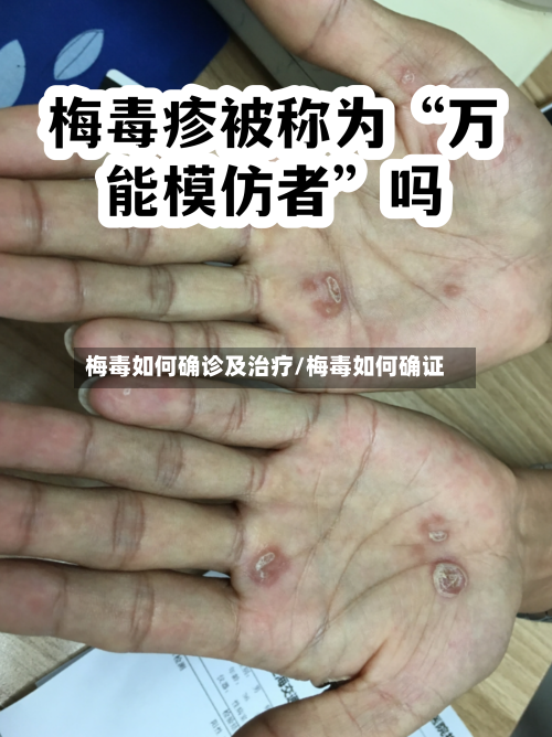 梅毒如何确诊及治疗/梅毒如何确证