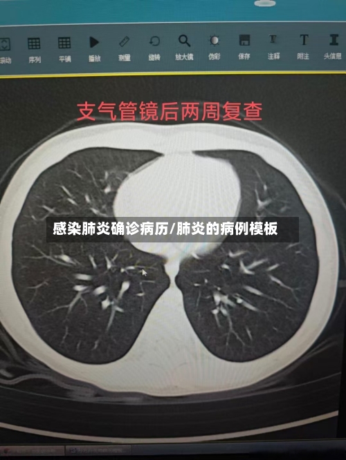 感染肺炎确诊病历/肺炎的病例模板