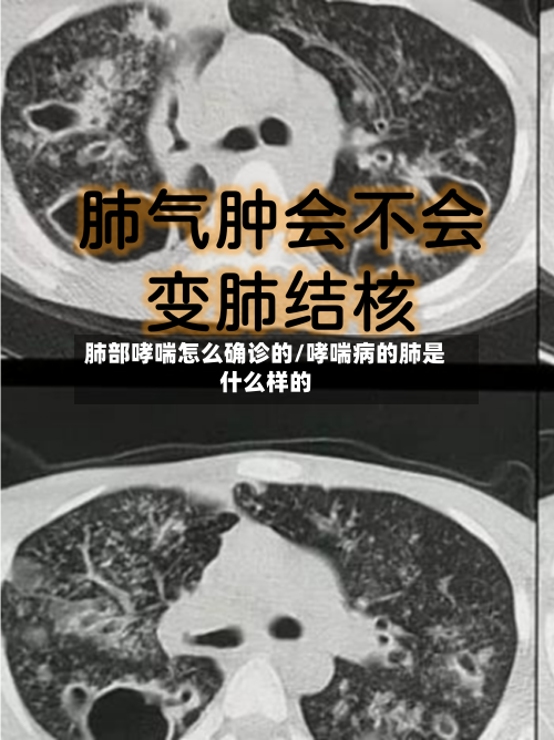 肺部哮喘怎么确诊的/哮喘病的肺是什么样的