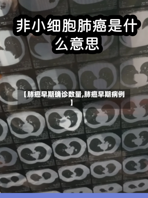【肺癌早期确诊数量,肺癌早期病例】