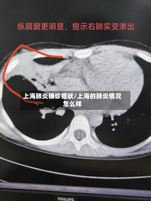 上海肺炎确诊症状/上海的肺炎情况怎么样