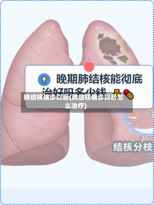 肺结核确诊以后(肺结核确诊以后怎么治疗)
