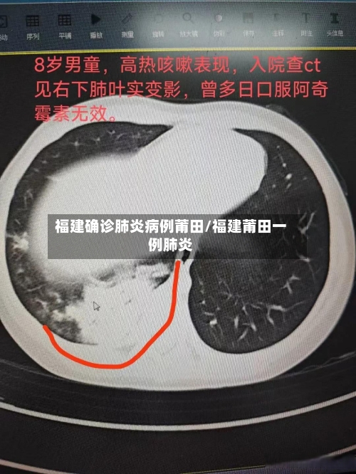 福建确诊肺炎病例莆田/福建莆田一例肺炎