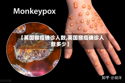 【英国猴痘确诊人数,英国猴痘确诊人数多少】