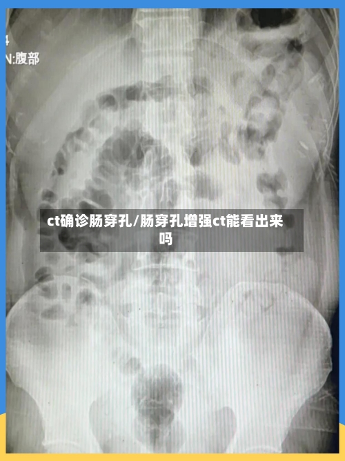 ct确诊肠穿孔/肠穿孔增强ct能看出来吗