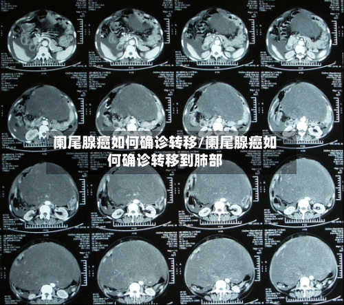 阑尾腺癌如何确诊转移/阑尾腺癌如何确诊转移到肺部