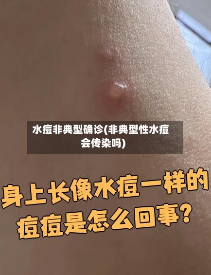 水痘非典型确诊(非典型性水痘会传染吗)