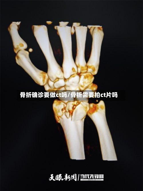 骨折确诊要做ct吗/骨折需要拍ct片吗