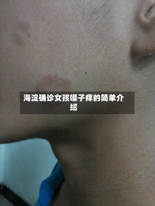 海淀确诊女孩嗓子痒的简单介绍