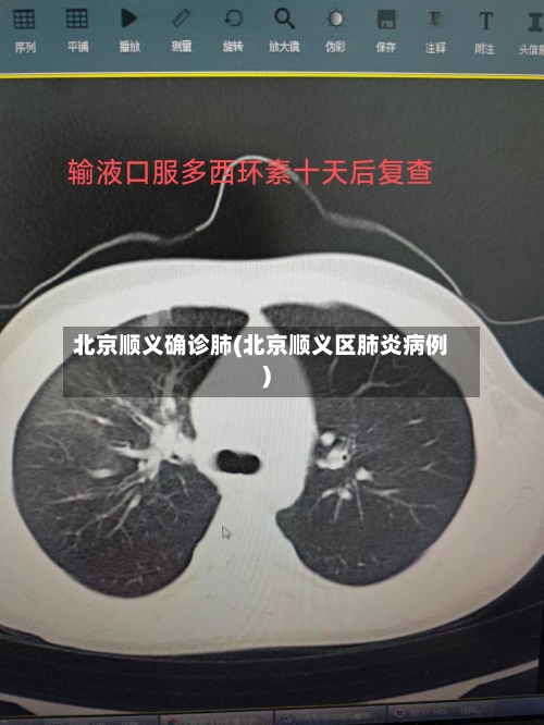 北京顺义确诊肺(北京顺义区肺炎病例)
