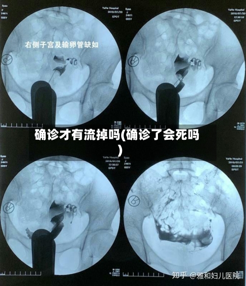 确诊才有流掉吗(确诊了会死吗)