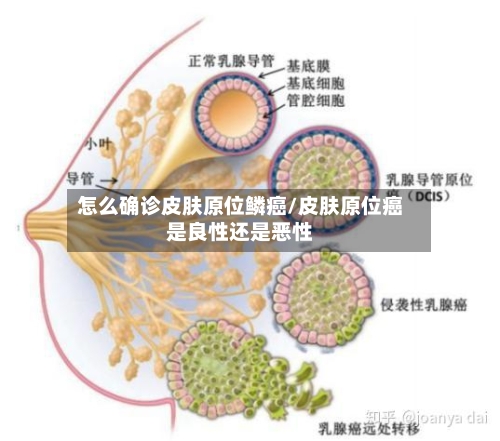 怎么确诊皮肤原位鳞癌/皮肤原位癌是良性还是恶性